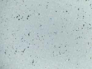 Figure 4 Fibrilation symptoms Fibrillation and fibres – What is it and how to get rid of them